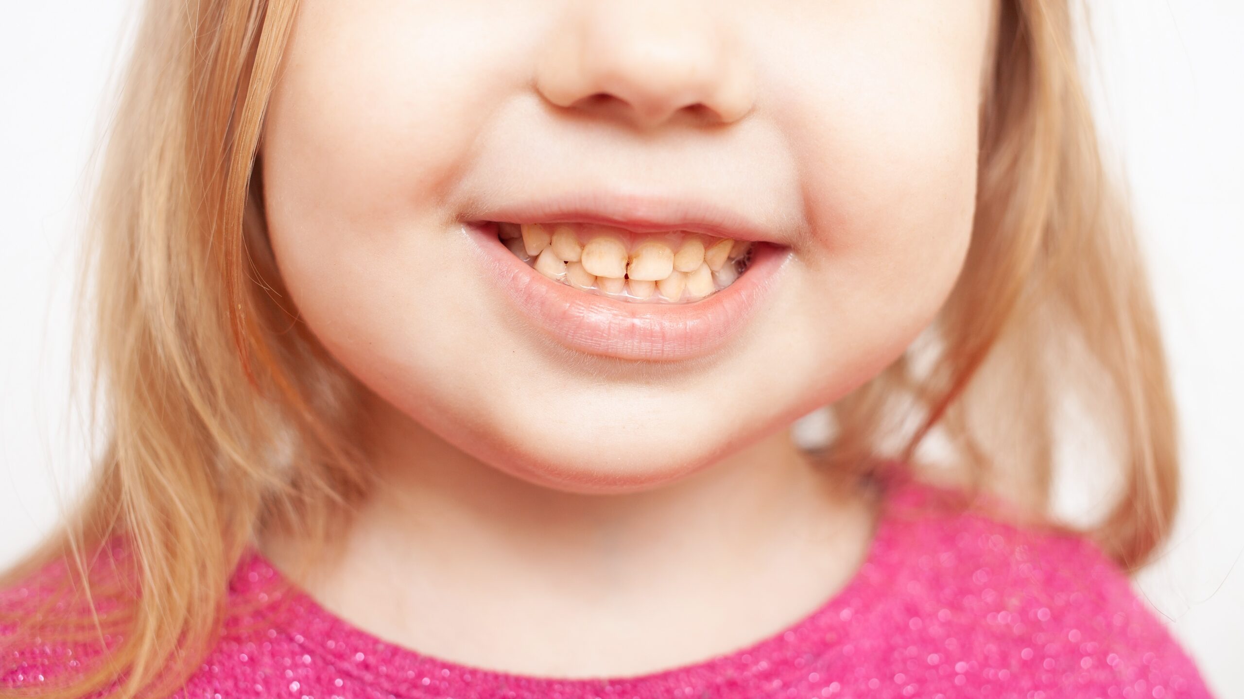 Girl child smiling before, white teeth after brushing and whitening, childhood. SSUCv3H4sIAAAAAAAACpxV247cIAx9r9R/GPHcSJg7/ZWqDyRhZtBmwigh092u9t9LSMiQvUp9C8c2ts+xyfP3b4cDqs3oGvTz8Dyf4tl13TSGwQTn+wjjHys+2L61Q4ncBipwCRhXnmzrgh+c6UqwNqE59+ZiI9hPXTfDL8mIxmDCNNqxqAUIHY7xTHN4O1hzGYNL8Rs6nqcQ7DAG3zyU+NX3LS+B2p2S0/Xsgy8NpvW1fRs/u7VTbzt7Ms3TzuQegykBO17fDS3BxvS3XVDjOz8NtX/c1dKZy5wLMnDxY0j3jaXbzTbB2r+pqoLFxgR7irTveMwa/1rOh2xYqwrRhNB68cLoVCcsQ8vl/xW5fPzeujvZPlH5/FJUPUSKzaL9WiMy0EpdM11BLY8Vk4JVmklSMQW8JVqLYy1TluVq9PAnjsAldb1eaqbW+YKFm29MlzgsMht3NYPZxV0H17j+VCA+nNPo55saP/VhmLtAQHXuH3XeX03dzZofYyab8bMZxxjRZryUK+6avxSpeh8SDSurqI16LnkoU4qBBqY4FZoDKtfm7OI9qaJc43TtvGntnHTTbFsoEJwD0ZSxTbv9biWHaKZ53t6u2exCBXBC7i5542YbkULIwvZ6+VYfRcTdZ7eH2UHIIsG6d9EmCVdaFPVtiyMiUVxymjdovy0gMaMchEhjcJ/teXQvLnb4CWWUUII/pYxLqoty37wga1OakU+7lpLBV9RJxehH1Est8ZfKKfiIWB3n625b3rZoUUAB40Kv/KKBkFoDwaroqnzcVruEYt52z1oUBfMoDOiPNROKQtZs99+IXbn2vf8GuhnX2eGJECwwxgpvq7pTDhGmqVKKks2+kwRxwPHBAbbu3DuKIMYFA0I431yyIAi0pBxHzTfTKz0QiSOLqdRQRK96IKVAggCV3rq1ZTePKOKtFk2ck+oIqqlidlGZ5mgrbo6xENWImrUx6uUfAAAA//8DALWzJHroBwAA